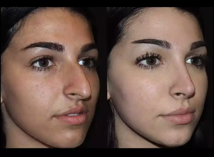 How to Find the Best Rhinoplasty Surgeon in Dubai for Your Needs