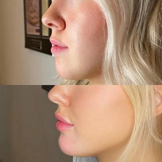 Expert Chin Fillers by Best Plastic Surgeon in dubai