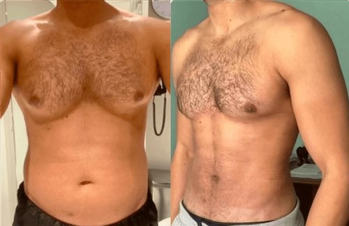 Top-Rated Clinics with the Best Gynecomastia Surgeons in Dubai