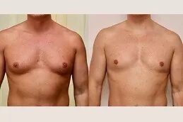 Best Gynecomastia Surgeons in dubai: Revolutionizing Male Confidence and Body Image