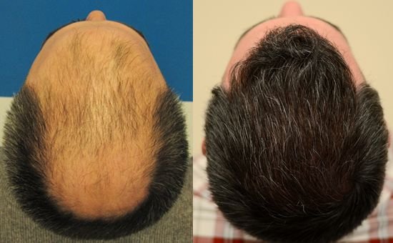 Before and After Hair Transplant: What You Need to Know