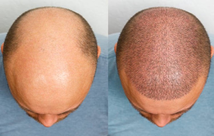 Discover Radiant Results: The Best Hair Transplant in Pune for Effective Hair Restoration