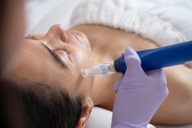 Top 5 Benefits of Microneedling in Ilford for Glowing Skin