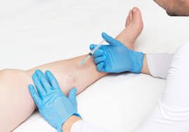 How Do You Know If You Need Vein Treatment in California?