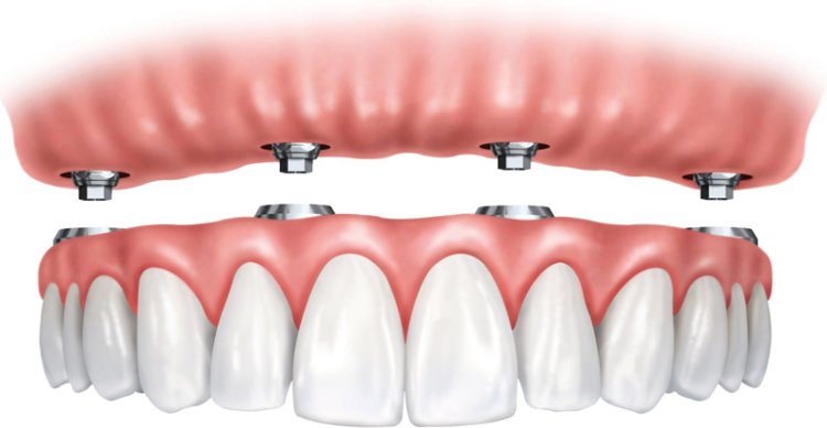 What is the Procedure for Getting All on Four Dental Implants Near Me?