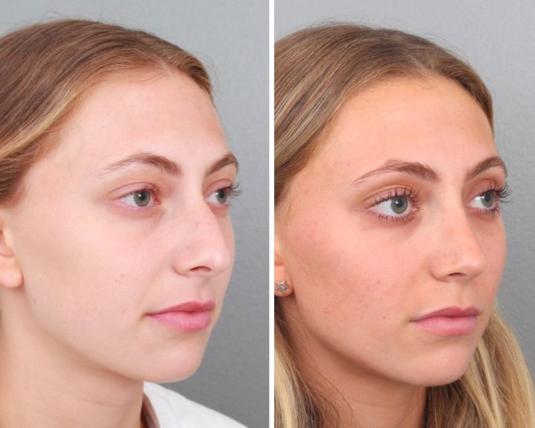 Chicago in Rhinoplasty: Achieving Harmony of the Face in the Midwest