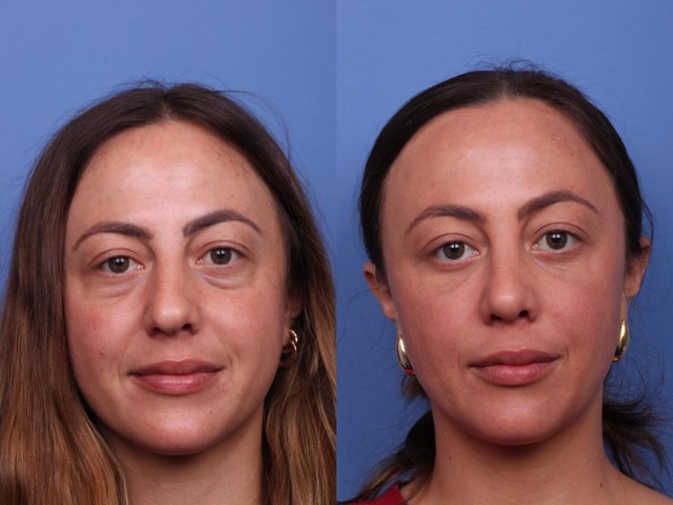 Understanding Blepharoplasty & Its 3 Stages