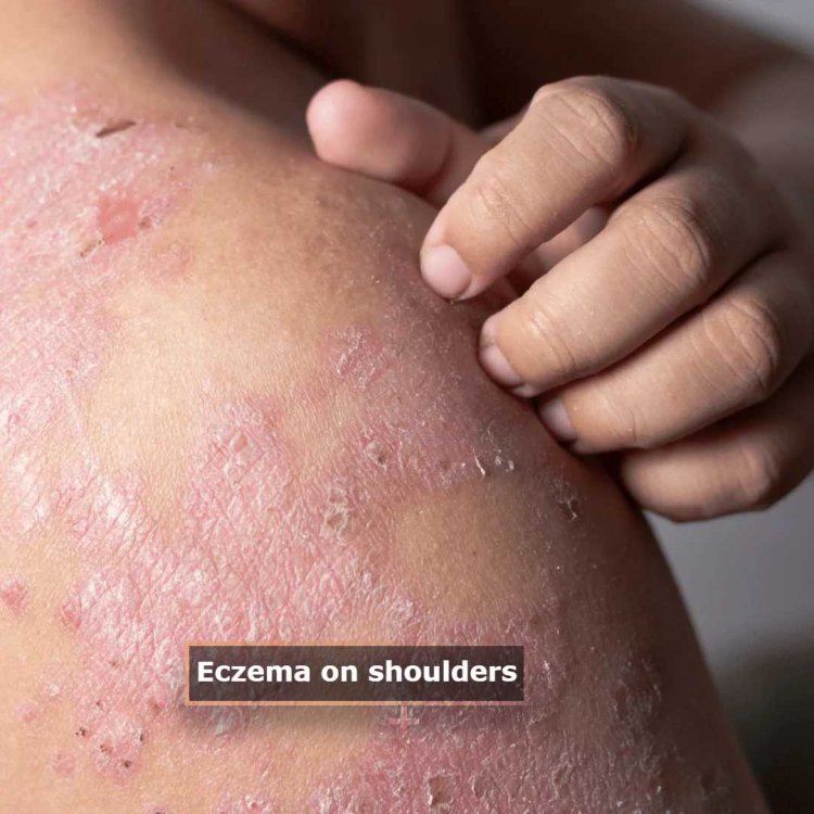 Eczema vs. Other Skin Conditions: Is It Really Eczema on the Shoulders?