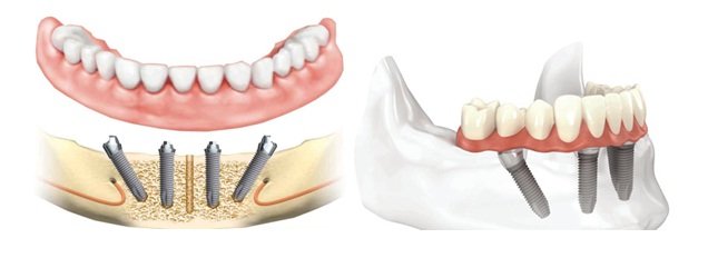 Are Dental Implants the Right Solution for Me?