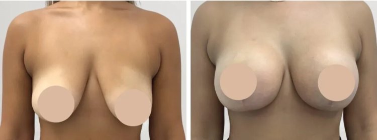 The Role of Experience in Choosing the Best Breast Lift Surgeons in dubai