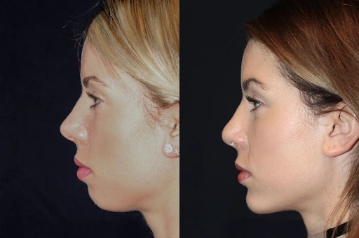 Best Aesthetic Clinic in dubai: The Ultimate Destination for Chin Fillers