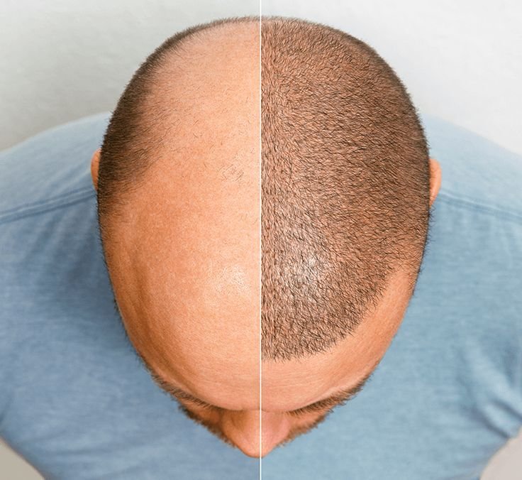 PRP Hair Treatment in Pune That Works Like Magic – Because Bald Spots Were Never a Trend!