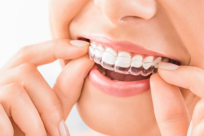 How Does an Invisalign Dentist Help You Achieve Perfectly Aligned Teeth?