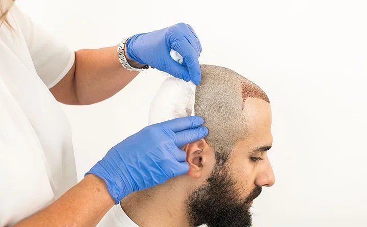 What to Know Before Getting a Hair Transplant