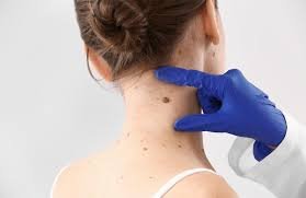 Skin Tag Removal Hammersmith: Safe & Effective Solutions for Smooth Skin